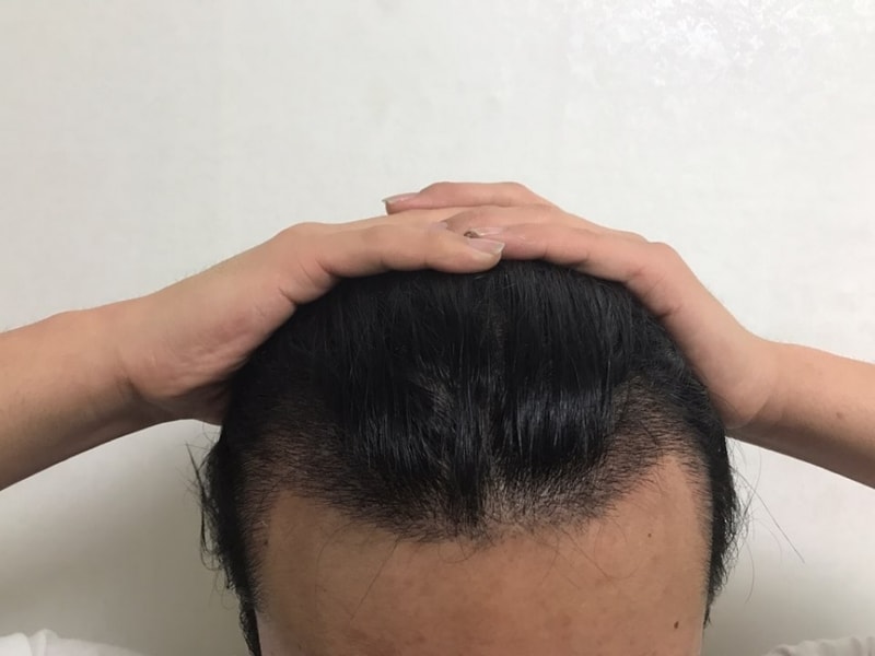 수술 16일후.jpg