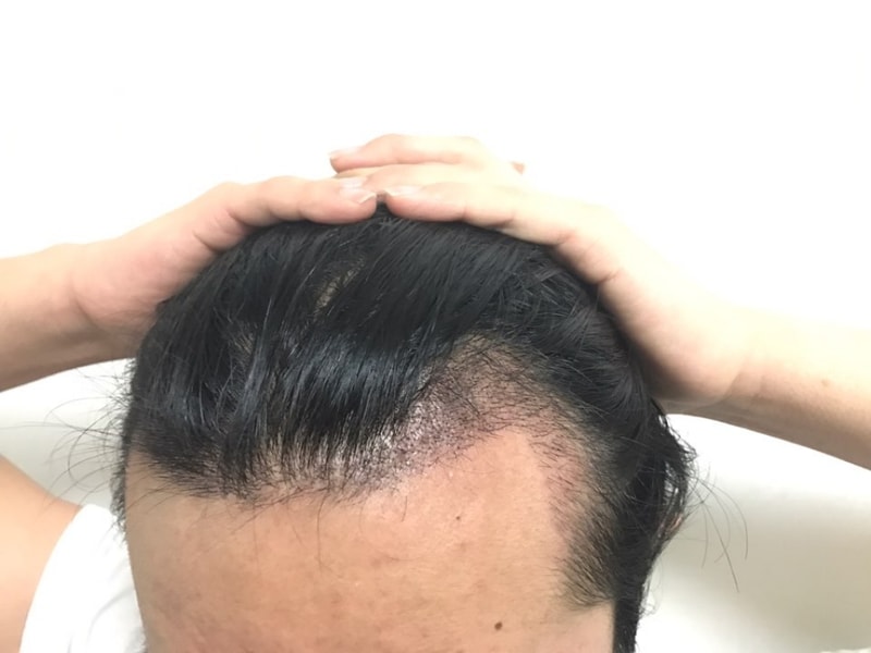수술 16일후3.jpg