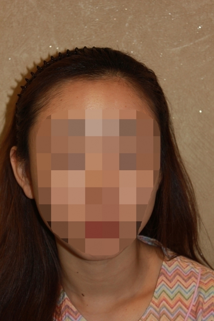 헤어라인교정 절개 2700모 제이피성형외과 후기에용^^