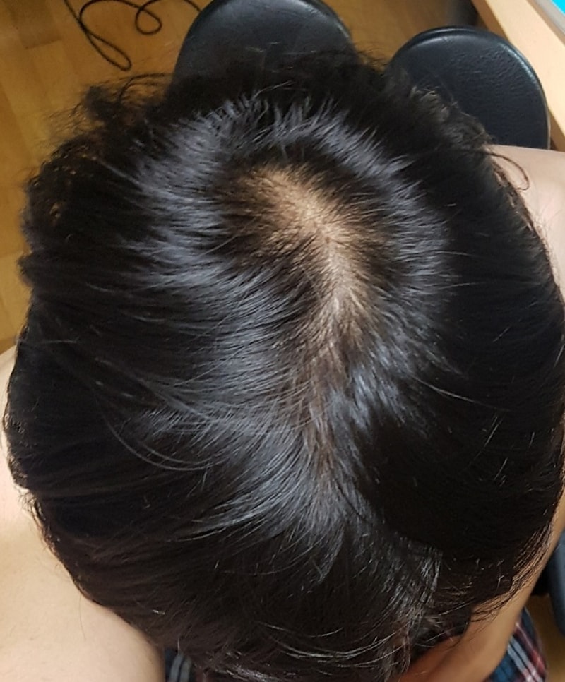 정수리 이식 4개월 점점 좋아집니다