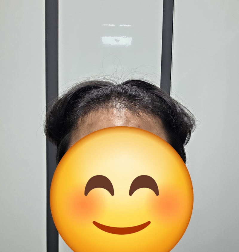 뉴헤어 m자 1500모낭 6개월 후기