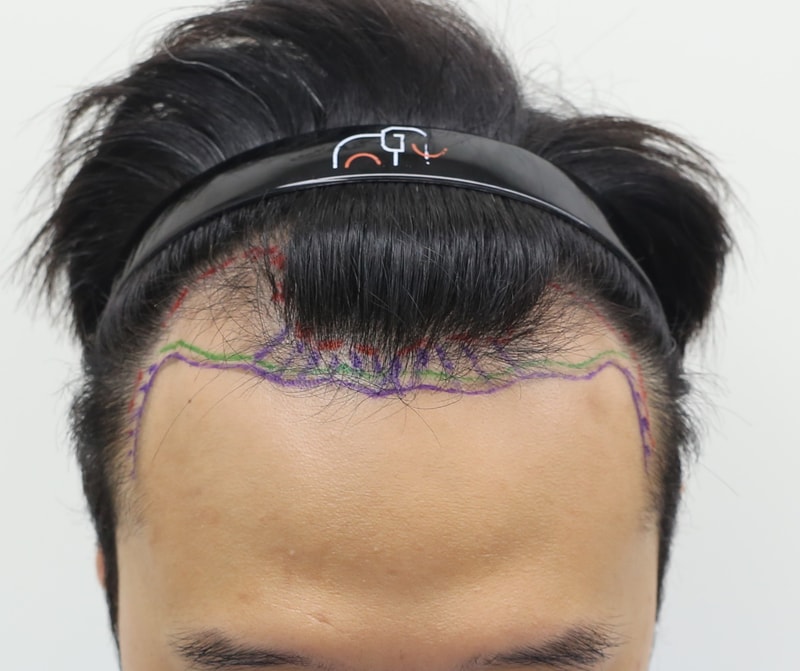 This is the review of the 5th day of hairline clinic in Apgujeong, Mammoth Hair Restoration Center.