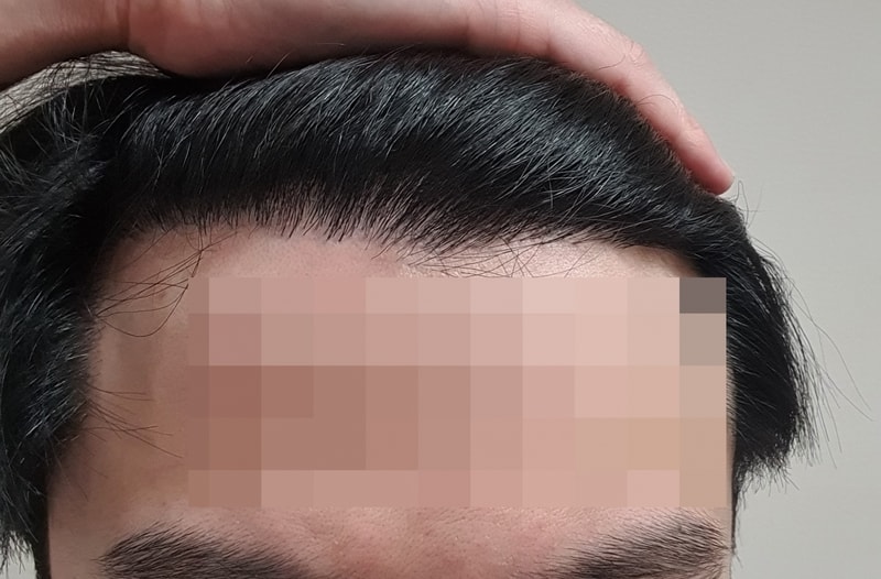 비절개 9개월 경과 사진입니다.