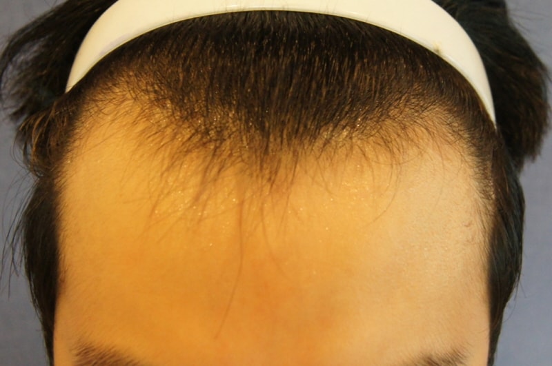 모션 800모낭 부분삭발 엠자 비절개 7개월 경과입니다