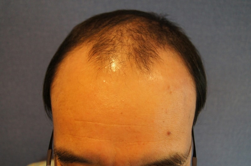 Motion 2000 Hair follicle 6 months old