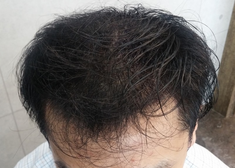 수술 3일차.jpg