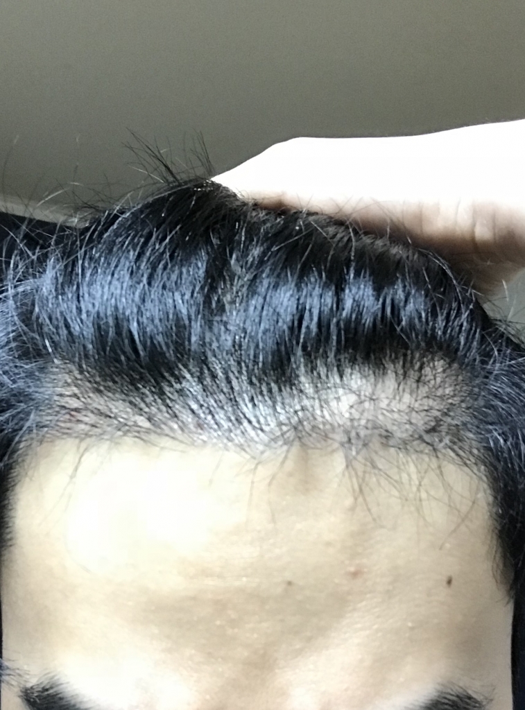 모재성 2000모 비절개 5개월차.. 실패인가요?