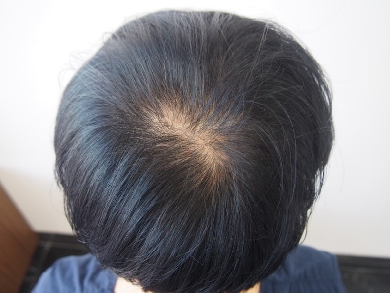 수정됨_정수리_수술전.jpg
