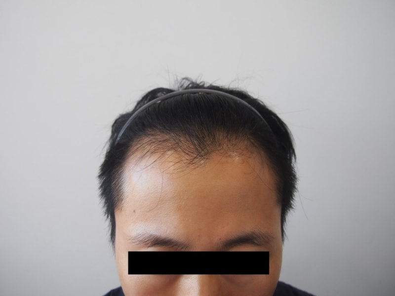 모재성 비절개 수술 후기 입니다. (수술 직후)