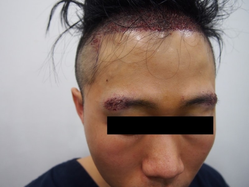 수정됨_눈썹(우)_수술후.jpg