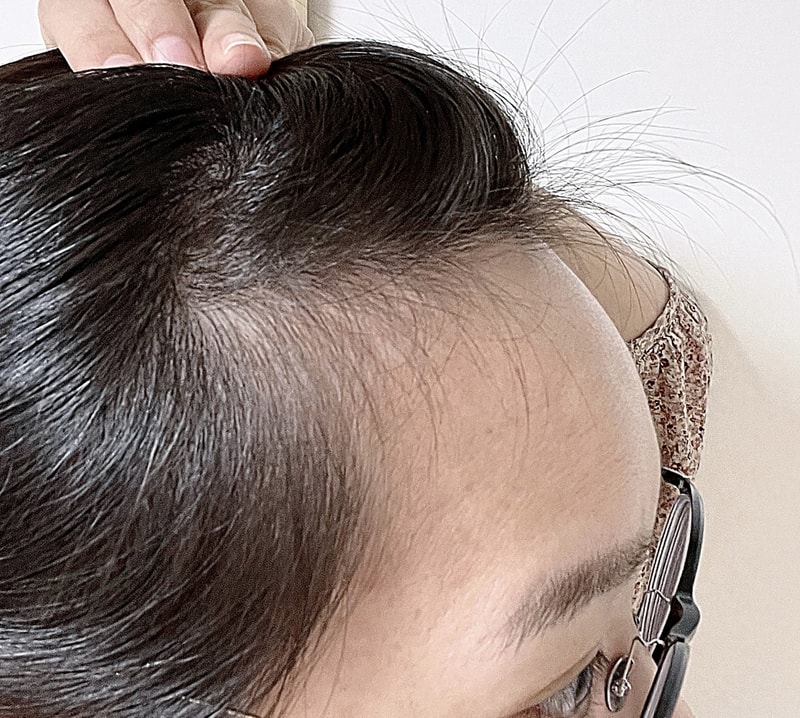 윤헤어라인에서 헤어라인 수술 23일차 후기