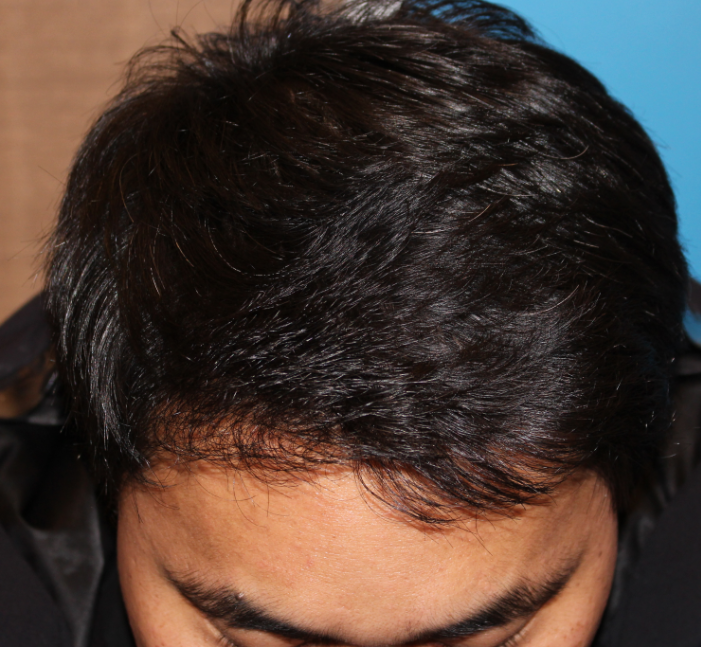 1년후 윗모습.png
