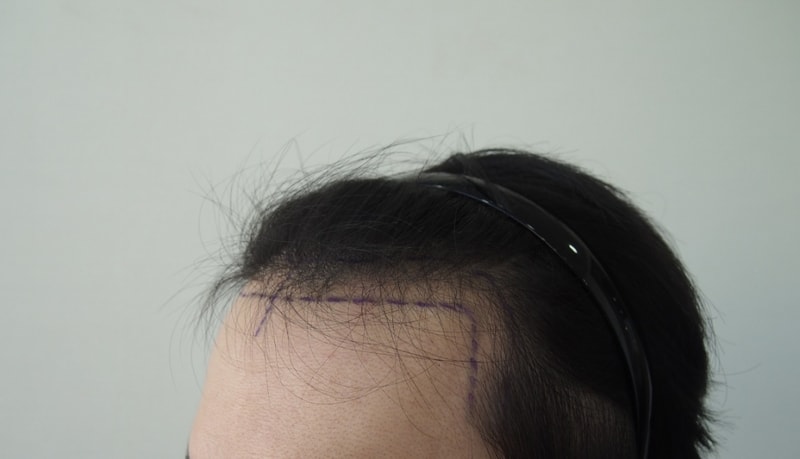 수술 전 왼쪽.jpg