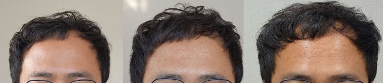 5800모 11일차 딱지제거