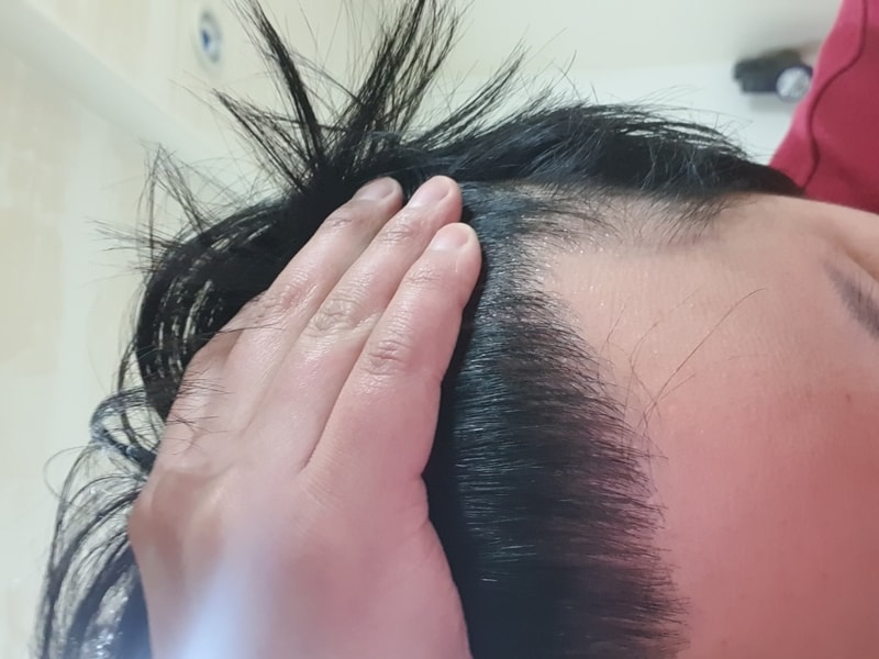 M자 비절개 모발이식 8개월차 후기