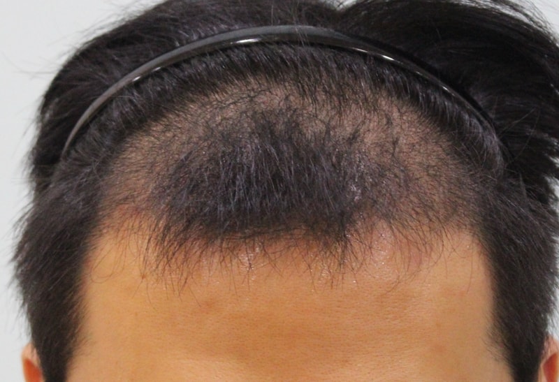 수술후 3개월 (5).JPG