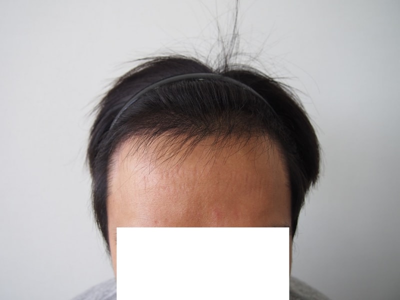 절개 3878모 수술 4개월