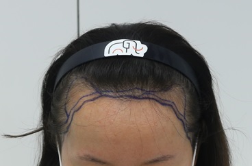 맘모스에서 M자 모발이식 수술다음날 후기입니다!