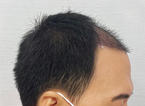 수술1일차02.jpg