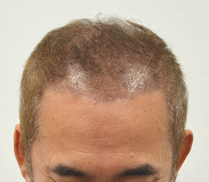 수술후 2주차.jpg