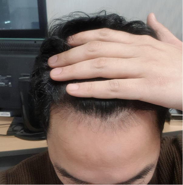 수술9개월차1.png
