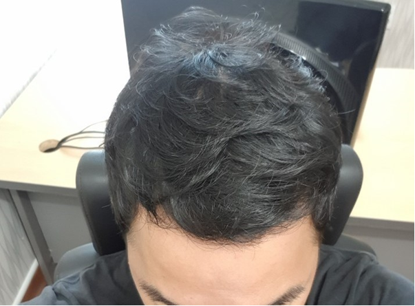 수술3개월차1.png