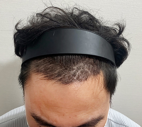 수술2주차1.jpg
