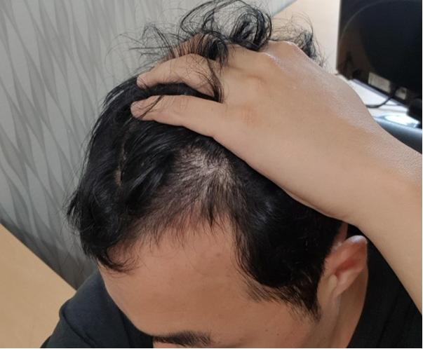 수술3개월차2.png