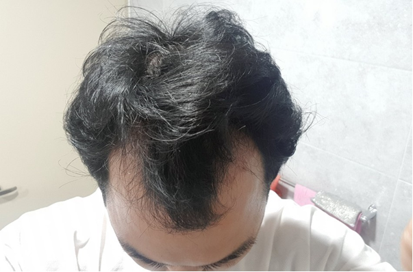 수술1개월차.png