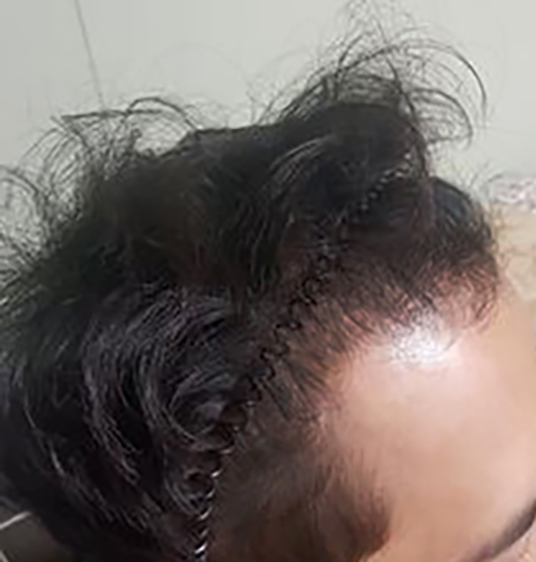 수술 후 7개월02.jpg