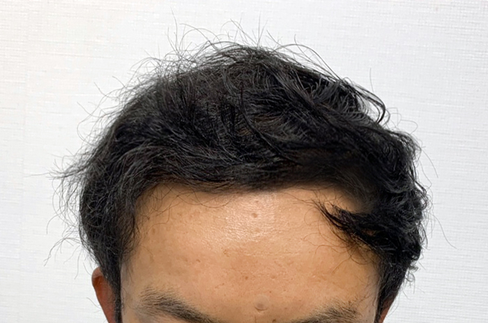 수술후 8~9개월차.jpg