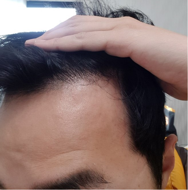 수술9개월차2.png
