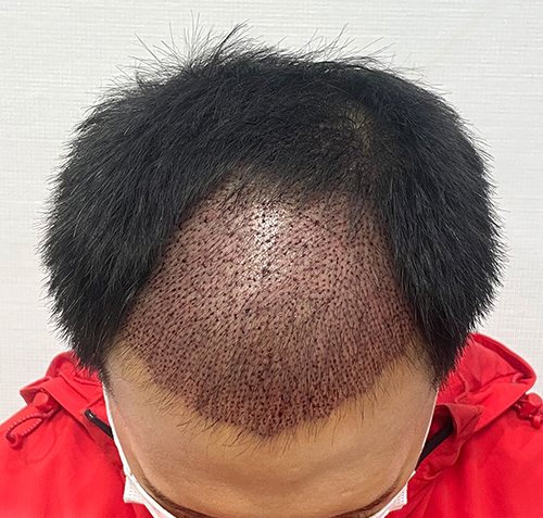 수술1일차01.jpg