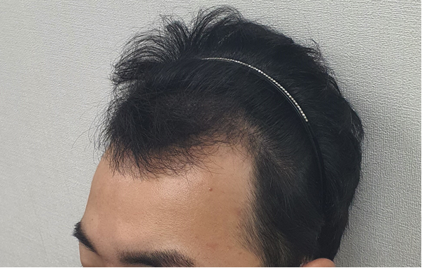 수술전.png