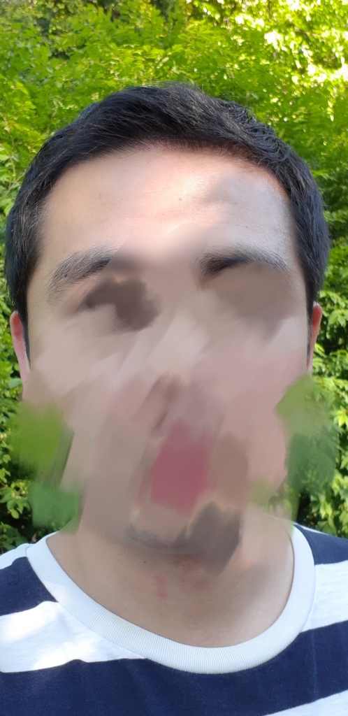 모재성 1500모낭 비절개 3개월차 사진입니다