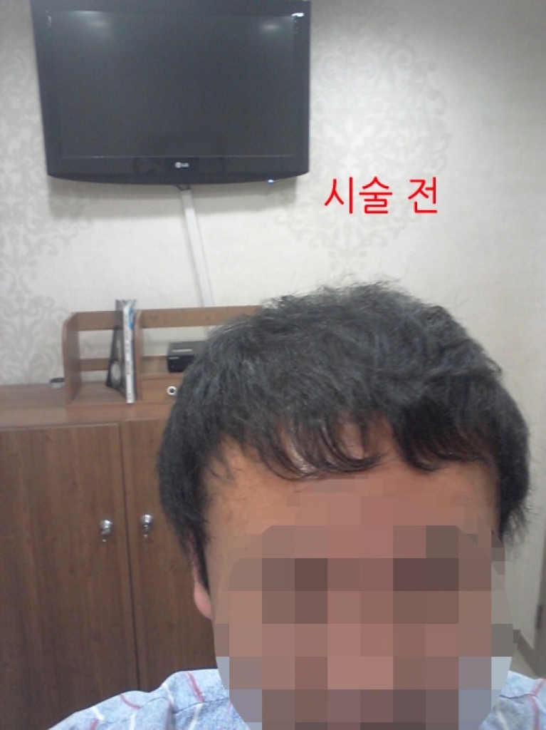 1. 시술전.jpg