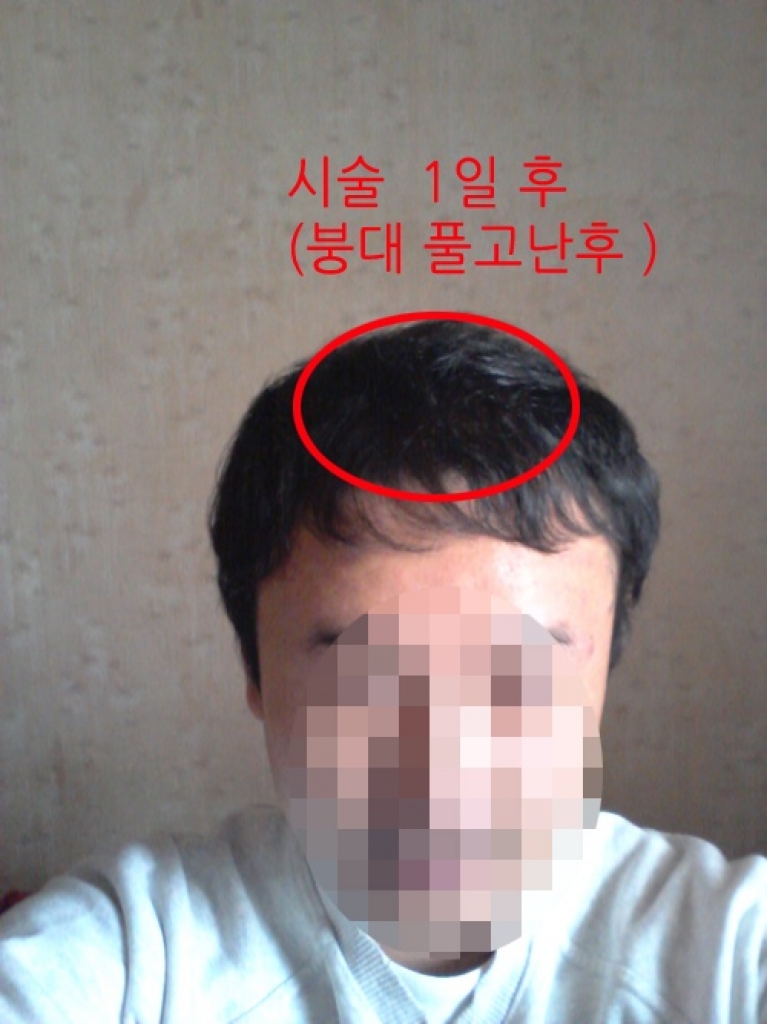3. 1일후.jpg