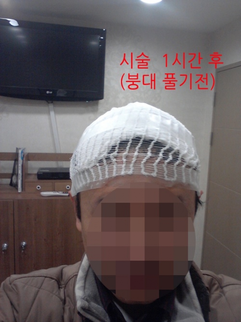2. 시술직후.jpg