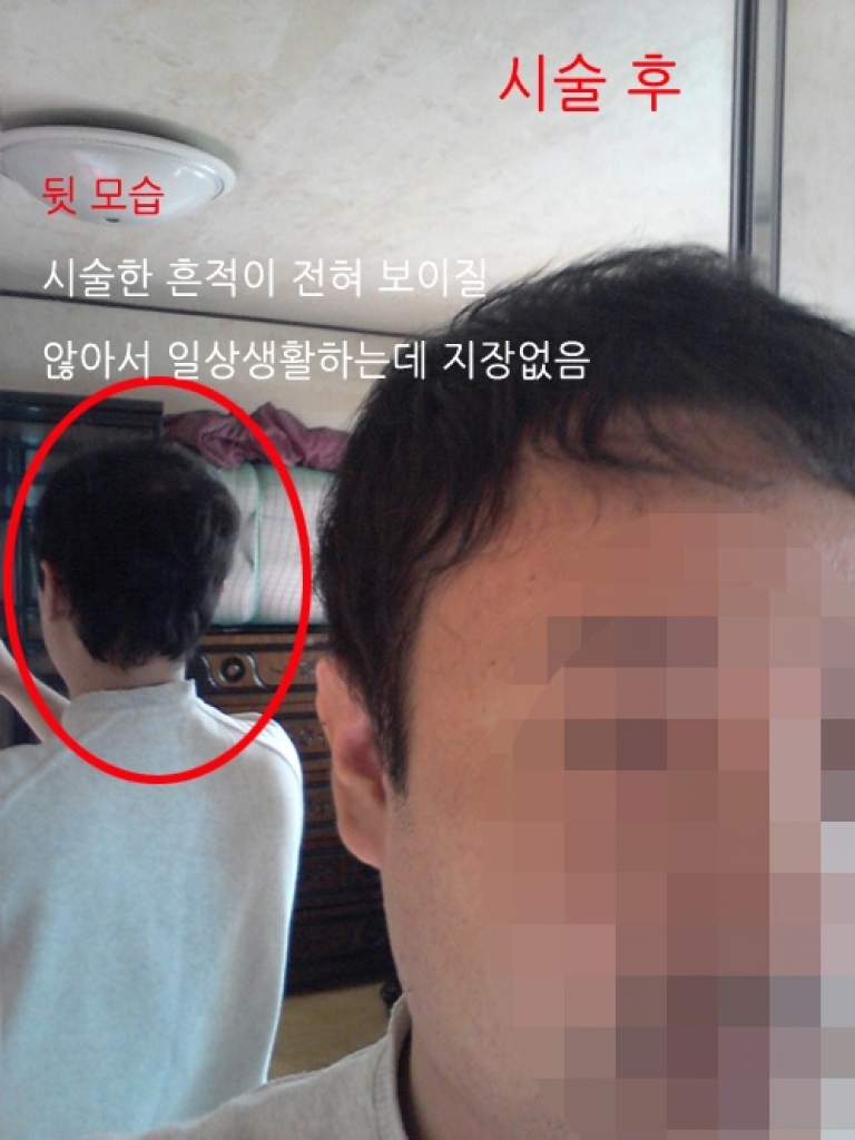 4. 3일후앞뒤.jpg