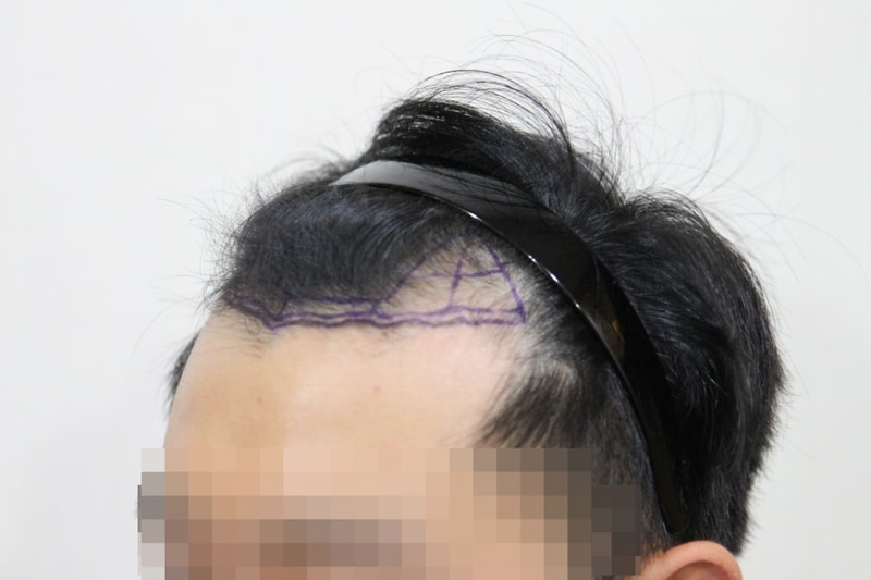 NHI 뉴헤어 절개법 1800모 6개월됐어요