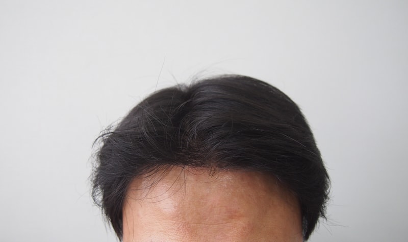 비절개 10개월차 경과 사진 입니다.