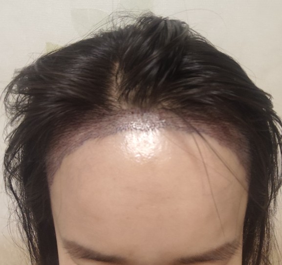 수술다음날.jpg