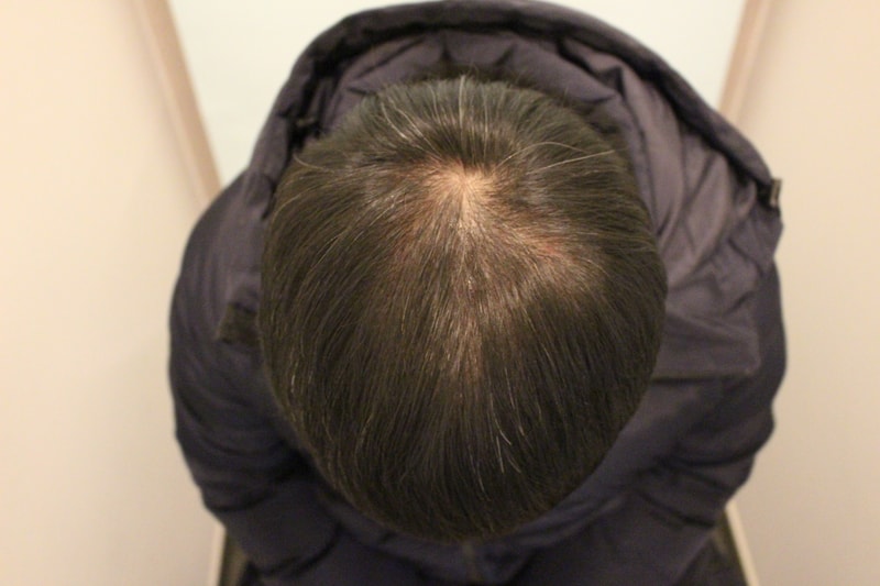 수술후 3개월 1.JPG