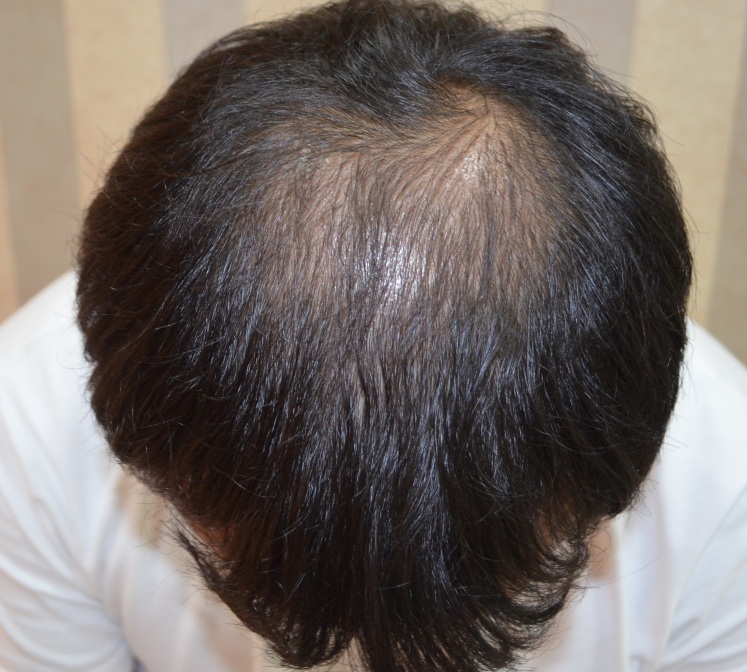 수술후 정수리.jpg