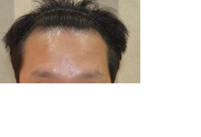 수술후 정면.jpg