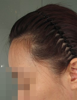 수술전 왼쪽.jpg