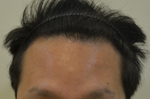 수술전 정면.jpg