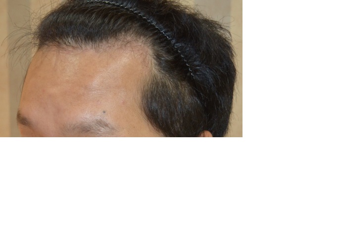 수술후 좌측.jpg