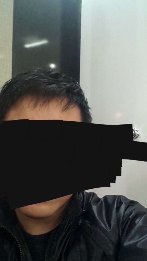 수술 1년 후-1.png