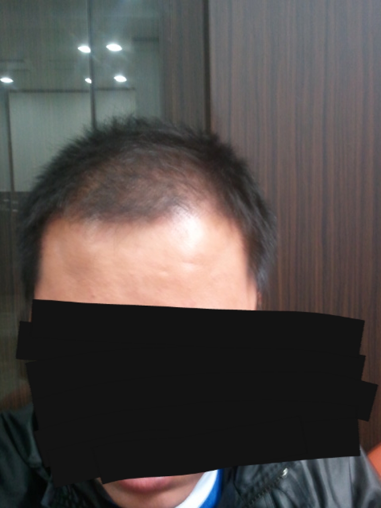 수술 5달 후.png